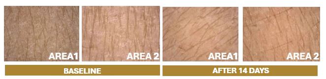 Skin at baseline and after 14 days