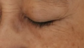 Eye area before