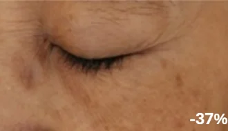 Eye area after, 37% fewer fine lines