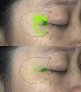 Before and after, eye area
