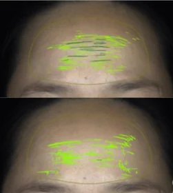 Before and after, forehead