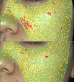 Before and after, acne inflammation